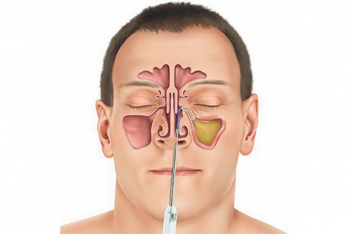 Гайморит онро тиби халқӣ муолиҷа мекунад?