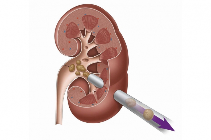 Сабабҳои пайдоиши санги талхадон