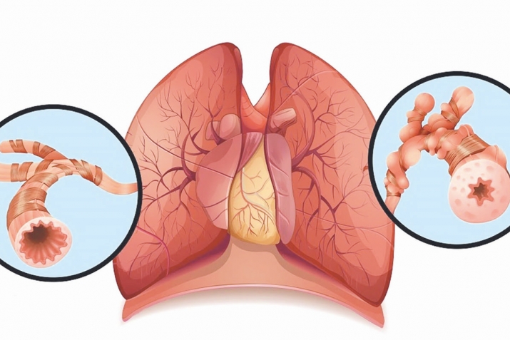 Хатари илтиҳоби шуш ва астма аз нигоҳи терапевт