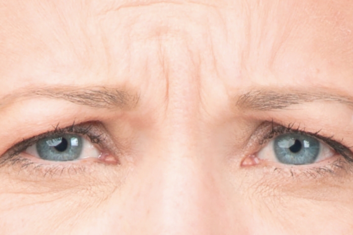 How to get rid of wrinkles on the forehead?