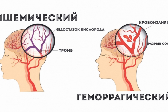 Инсульт. Сабпи дакьикьйирикан уьмур асиллу шула